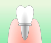 歯冠の取り付けのイメージ